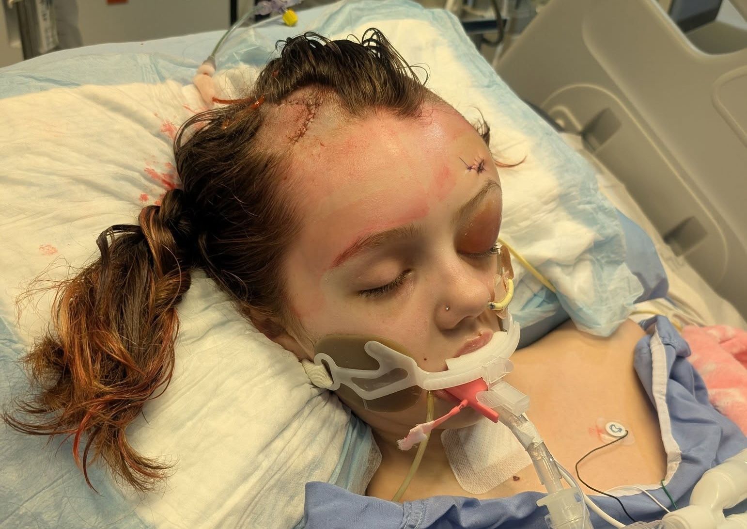 A young girl lays in a hospital bed with an intubation tube in her mouth